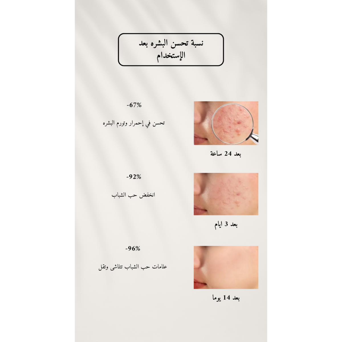 ⁦ليون بير , كريم معالجة الحبوب | PAIR Acne Cream W⁩ - الصورة ⁦5⁩
